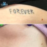 сколько стоит удаление татуировок