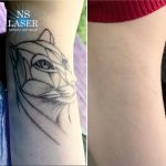 удаление татуировок лазером красноярск